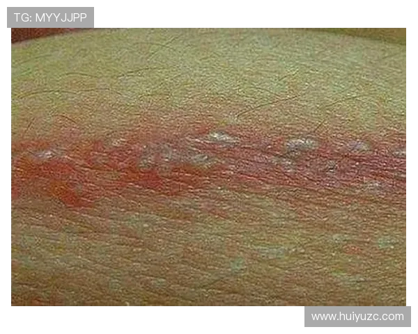 哈利伯顿染带状疱疹服药致体重激增